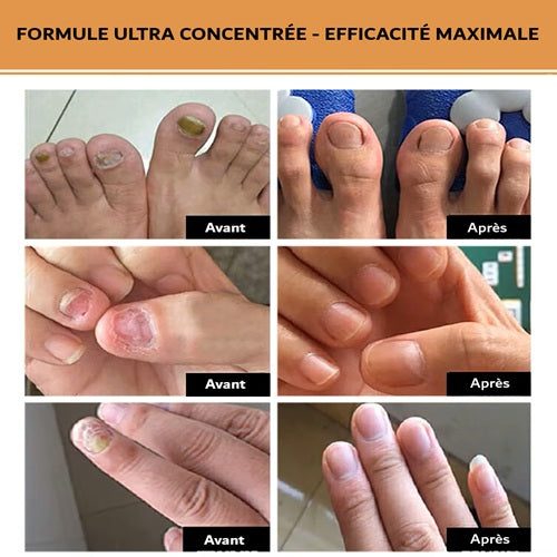 Sérum réparateur concentré pour ongles abimés Lepi Nohti Nails™