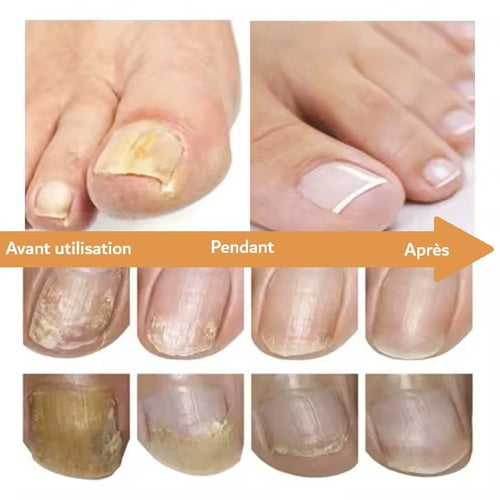 Sérum réparateur concentré pour ongles abimés Lepi Nohti Nails™
